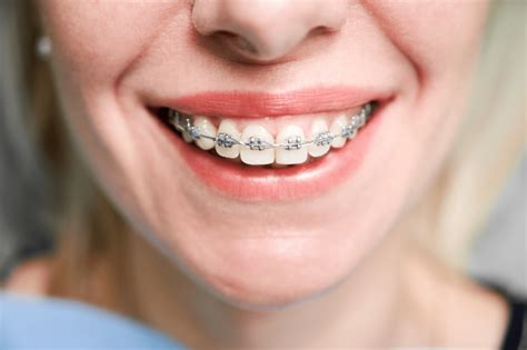 precio de brackets metalicos en argentina|brackets de autoligado.